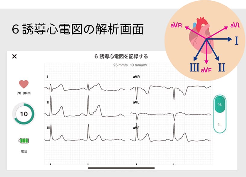 ６誘導心電図の解析画面