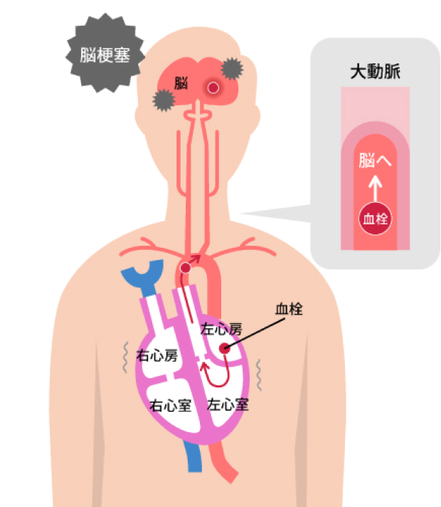 心房細動のイラスト