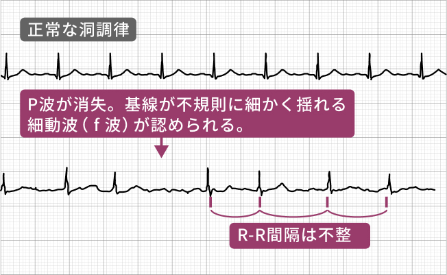 心電図の波形比較
